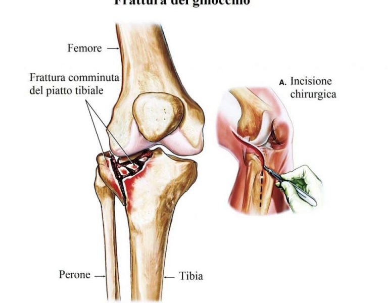 Liquido rodilla que hacer